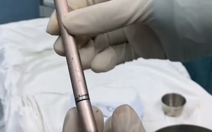 Thiếu nữ dùng cây bút gãi ngứa vùng kín rồi bị mắc kẹt trong bàng quang