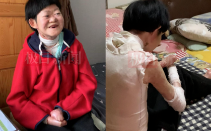 Từng bị chẩn đoán không sống quá 2 tuổi, “cô gái bươm bướm” hiện tại ra sao ở tuổi 25?