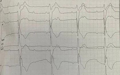 Tim đập hơn 200 nhịp/phút, huyết áp tụt sâu - người bệnh thoát "cửa tử" nhờ cấp cứu kịp thời