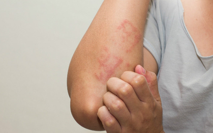 Ngứa không dứt, người phụ nữ 37 tuổi phát hiện cơ thể nhiễm tới 5 loại ký sinh trùng