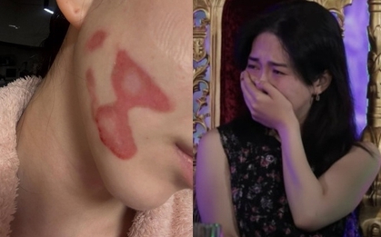 Nữ thần sắc đẹp showbiz bị bỏng mặt nghiêm trọng hậu thẩm mỹ, nhìn tình hình hiện tại mà xót thay