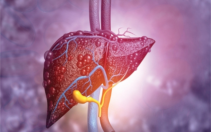 Có 1 dấu hiệu kéo dài suốt 3 tháng, người đàn ông đi khám phát hiện gan “dày đặc khối u”
