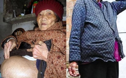 Cụ bà 91 tuổi ngã khi đi lấy nước, vào viện thì phát hiện “mang thai”: Bí mật về "bào thai hoá đá"