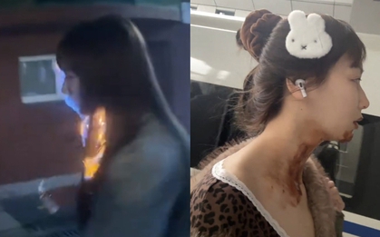 Nữ diễn viên bị bỏng nặng gương mặt ngay trong ngày sinh nhật tuổi 27 vì đu trend "bánh kem phun lửa"