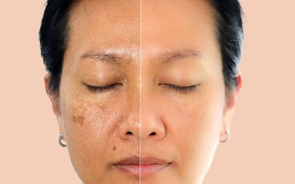 Oxy cao áp: Khi nào dùng để làm đẹp, chống lão hóa và kiểm soát bệnh chuyển hóa?