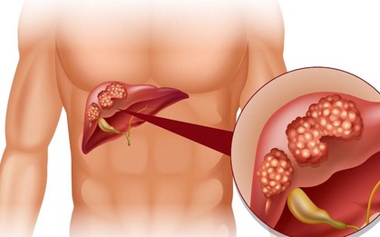 Cảnh báo từ WHO: 1 loại ĐỘC TỐ gây ung thư ẩn trong nhiều thực phẩm quen thuộc mà người Việt ĂN MỖI NGÀY