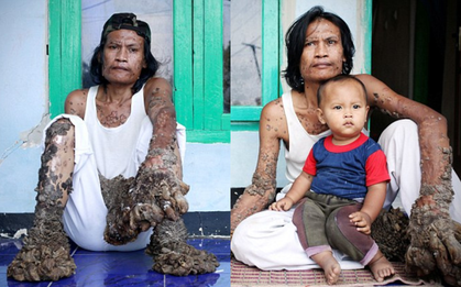 42 năm cuộc đời đầy bi kịch của "người cây"