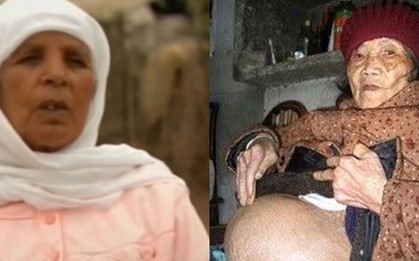 Người phụ nữ mang thai suốt 46 năm mà không hề hay biết cho đến khi 75 tuổi