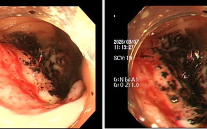 Ngày càng nhiều người trẻ bị ung thư đại trực tràng, Bệnh viện Nhân dân 115 đưa ra khuyến cáo KHẨN