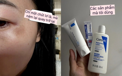 Tôi lười chống nắng vài ngày và nám quay lại rõ rệt: Đây là sai lầm nhiều người mắc phải!