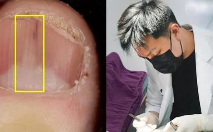 Người phụ nữ 45 tuổi phát hiện khối u từ 1 dấu hiệu ở móng tay nhiều người bỏ qua