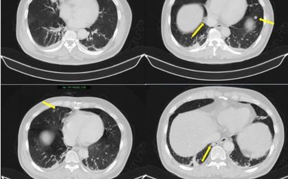 Người đàn ông phát hiện mắc hai bệnh ung thư cùng lúc