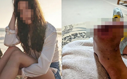 Cô gái 20 tuổi hoại tử, phải cắt bỏ 2 ngón chân vì mỗi ngày đều uống 1 loại nước "vạn người thích"