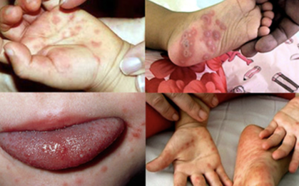 Sốt xuất huyết tăng 2,2 lần, tay chân miệng gấp 5 lần