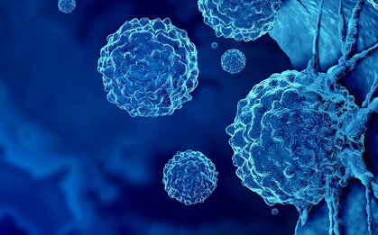 Loại ung thư đứng thứ 2 về tỉ lệ tử vong tại Việt Nam: 5 dấu hiệu sớm nhất ai cũng nên biết