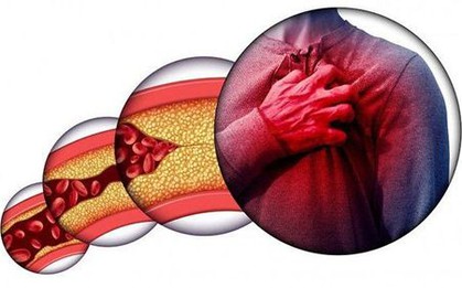 Gầy nhưng mỡ máu vẫn cao vút: Không hề vô lý, "thủ phạm" chính là đây