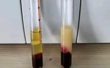 Vì sao tôi luôn kiểm soát mỡ máu nhưng khi khám lại vẫn không cải thiện, thậm chí bị nặng hơn?