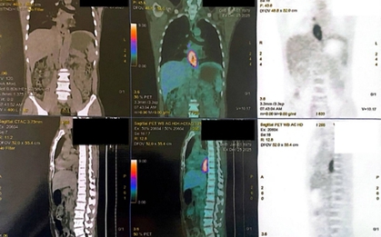 Nuốt nghẹn, sụt 5 kg, đi khám phát hiện mắc hai loại ung thư