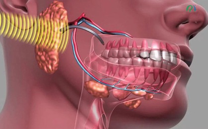 U xương hàm là bệnh gì? Dấu hiệu nhận biết sớm nhiều người dễ bỏ qua