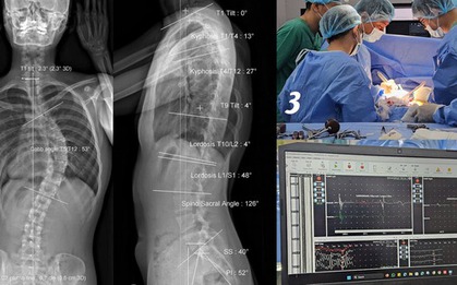 Cô gái soi gương thấy lưng có dấu hiệu lạ, không ngờ cột sống đã cong 53 độ