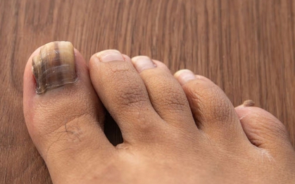 Dấu hiệu ở móng chân cảnh báo loại ung thư nguy hiểm: Nhiều người bỏ qua, bác sĩ khẩn thiết nhắc nhở