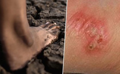 Thái Lan cảnh báo khẩn về dịch "sốt đất": 732 ca nhiễm, 23 trường hợp tử vong