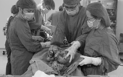 Đau âm ỉ vùng bụng suốt, người phụ nữ sốc khi bác sĩ lấy ra thứ "đáng sợ" trong cơ thể mình