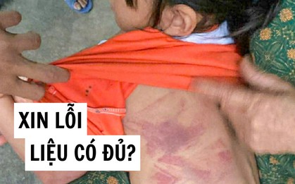 Tôi bàng hoàng khi xem bức ảnh bé gái Tiểu học bị bạn nam cùng lớp đánh bầm lưng: Hỏi thật, một lời xin lỗi liệu có đủ?