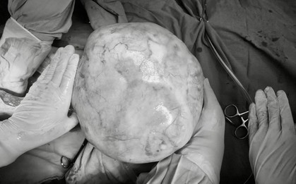 Hy hữu: Bé gái 14 tuổi mang khối u buồng trứng hơn 4kg, bác sĩ cảnh báo những dấu hiệu sớm nhưng hay bị bỏ qua