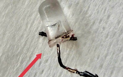 Bác sĩ thót tim gắp đèn LED nằm trong phế quản bé 9 tháng tuổi