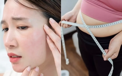 Không phải do bạn lười tập: Đây mới là lý do khiến nhiều người không thể "đốt mỡ", càng giảm cân càng thấy mụn