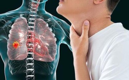 Không phải ho dai dẳng: 5 DẤU HIỆU cảnh báo ung thư phổi nhiều người vẫn lầm tưởng là bình thường