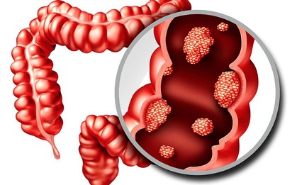 6 dấu hiệu cảnh báo đỏ của "căn bệnh ung thư đáng sợ": Có 1 cũng cần đi khám ngay!
