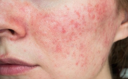 Hydroquinone và rủi ro từ hoạt chất "làm hồng" thần tốc trong mỹ phẩm