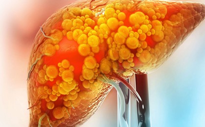 5 “thủ phạm” khiến gan ngập trong mỡ: Ít ai ngờ tới