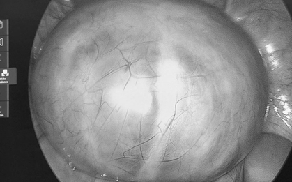 Đau bụng tưởng nhẹ, người phụ nữ sốc nặng khi bác sĩ lấy ra thứ “rợn người” trong cơ thể