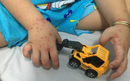 Sốt xuất huyết, tay chân miệng tăng trong tháng 4