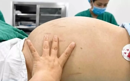 Tưởng bụng lớn do tăng cân đơn thuần, tá hỏa khi biết mình bị u buồng trứng