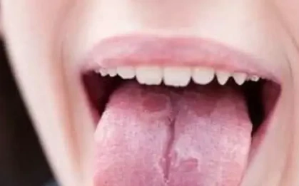 Nấm miệng họng do Candida: Cảnh báo từ những mảng trắng bất thường