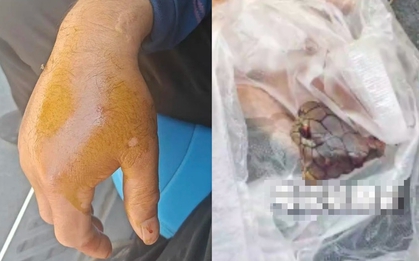 Bị rắn hổ mang chúa dài 2 mét cắn, người đàn ông chém đứt xác rắn rồi đến bệnh viện