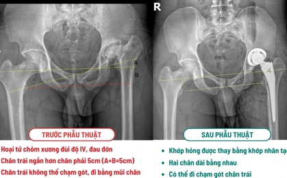 Khách Tây là kỹ sư vượt 10.000km sang 1 bệnh viện ở Việt Nam phẫu thuật: "Trước đây tôi chưa từng nghĩ có ngày gót chân chạm đất"