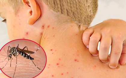 Dịch sốt xuất huyết tăng cao, chuyên gia cảnh báo biến chứng nặng của bệnh