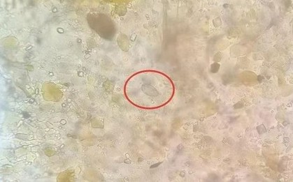 Ăn món khoái khẩu trong chuyến du lịch, người đàn ông 40 tuổi "sốc nặng" khi đến bệnh viện khám