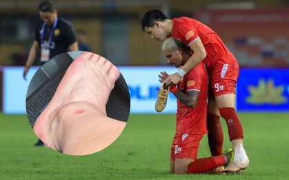 Đình Bắc lộ ảnh cổ chân sưng biến dạng sau trận vô địch V.League cùng CLB CAHN