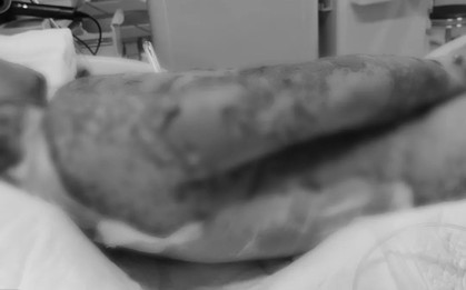Người đàn ông 35 tuổi bị tróc da như "cua lột" toàn thân, suýt mất mạng vì kiểu dùng thuốc cực kỳ phổ biến