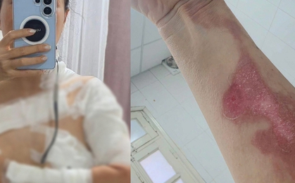 Đi gội đầu dưỡng sinh, cô gái nhận "combo sự cố": Bỏng độ 2, tự đi cấp cứu vì nồi xông hơi phát nổ?