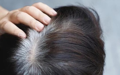 Người trẻ tóc bạc sớm: Bác sĩ chỉ ra 3 dưỡng chất hay bị thiếu hụt, ít người để ý đến