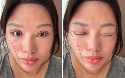 Phẫu thuật mí mắt hỏng, nạn nhân còn bị kiện ngược
