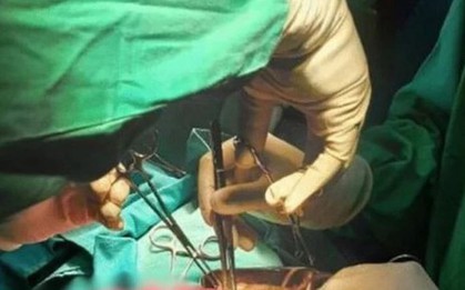 Bé trai 3 tuổi nôn ra giun, khi phẫu thuật bác sĩ phát hiện điều đáng sợ hơn