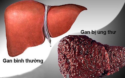 Người thuộc nhóm nguy cơ cao mắc ung thư gan cần làm gì?